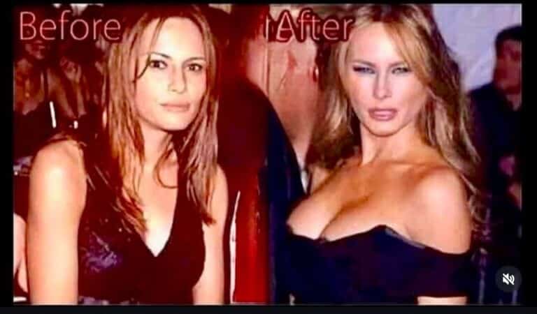 Before And After Photos Of Melania Go Viral – People Think She Looks Almost Unrecognizable