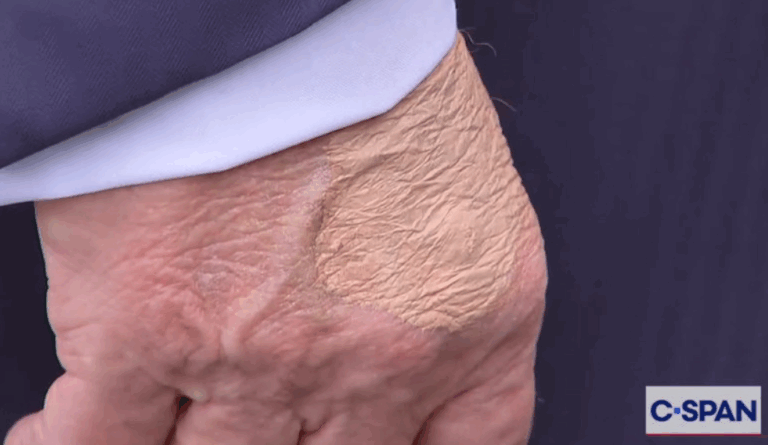 White House Tried To Explain Away What People Think Is Make-Up On Trump’s Hand, Failed Miserably